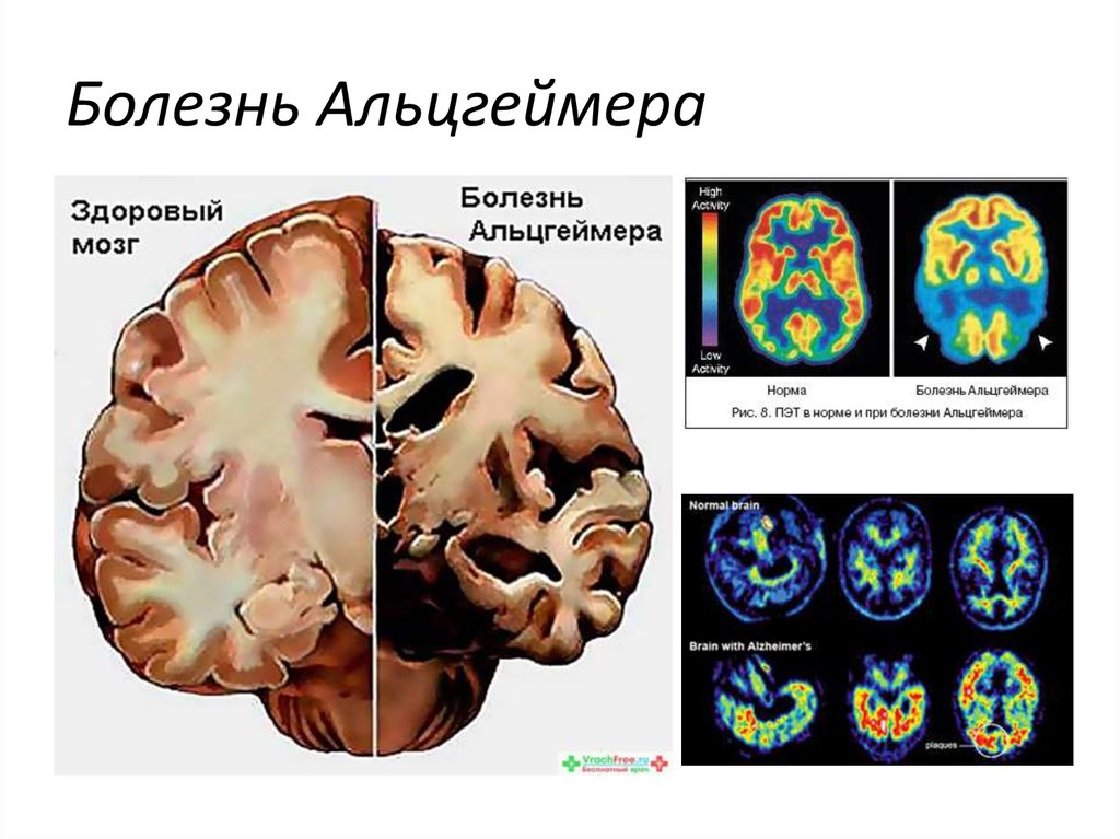 Болезнь Альцгеймера