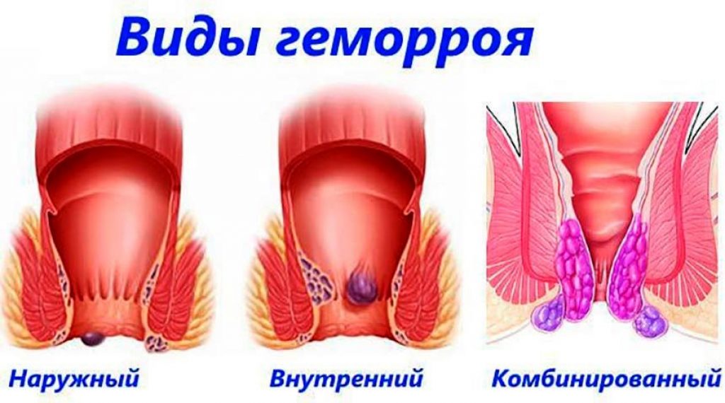 Геморрой: внутренний и наружный. Симптомы, признаки, профилактика
