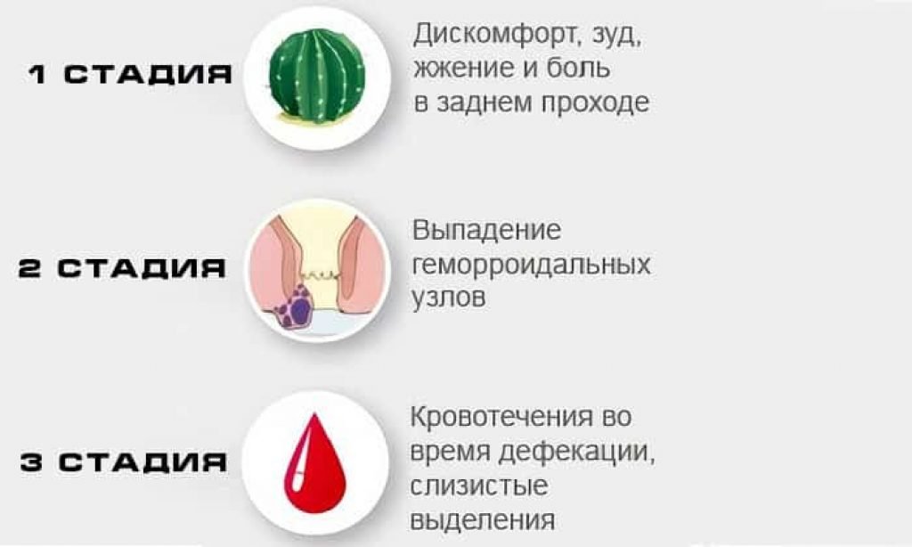 Геморрой: внутренний и наружный. Симптомы, признаки, профилактика