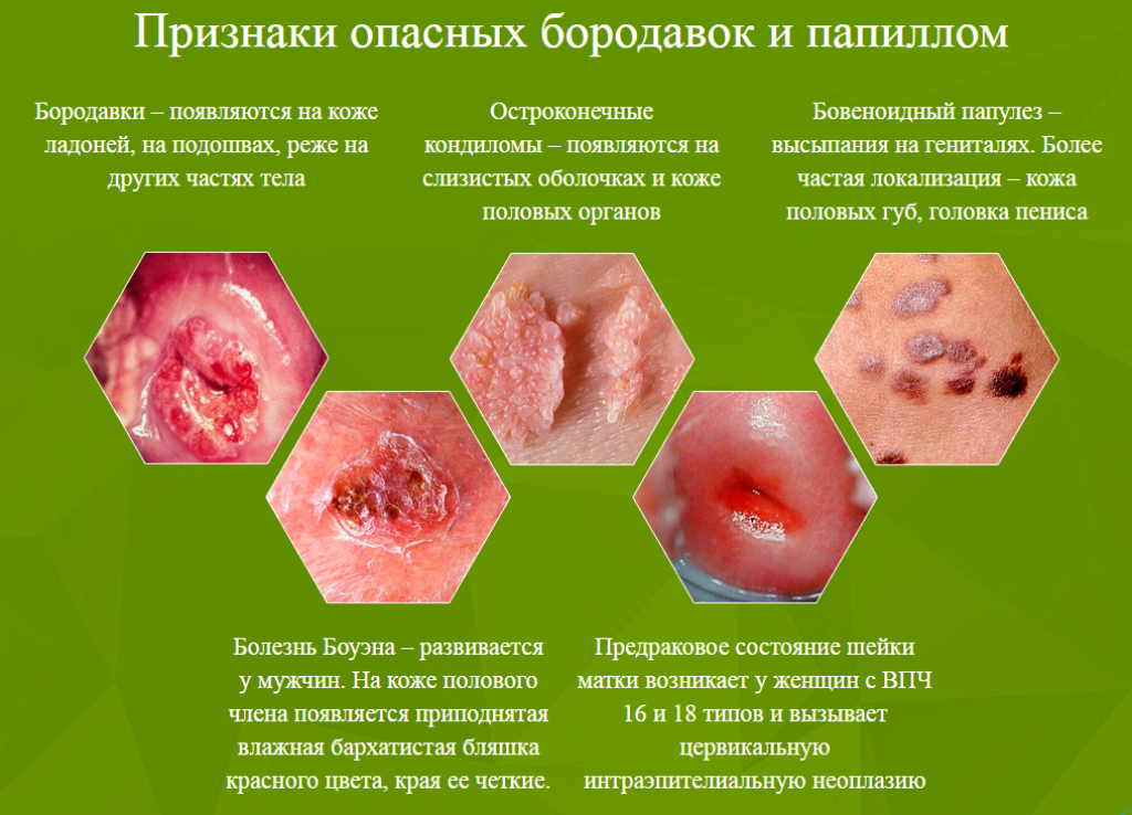 Папилломавирусная инфекция: виды, диагностика, лечение