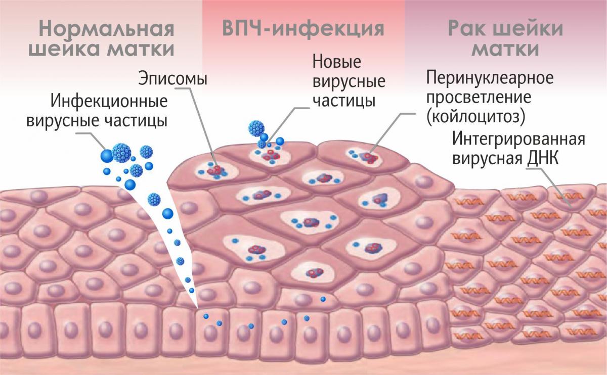 Папилломавирусная инфекция: виды, диагностика, лечение
