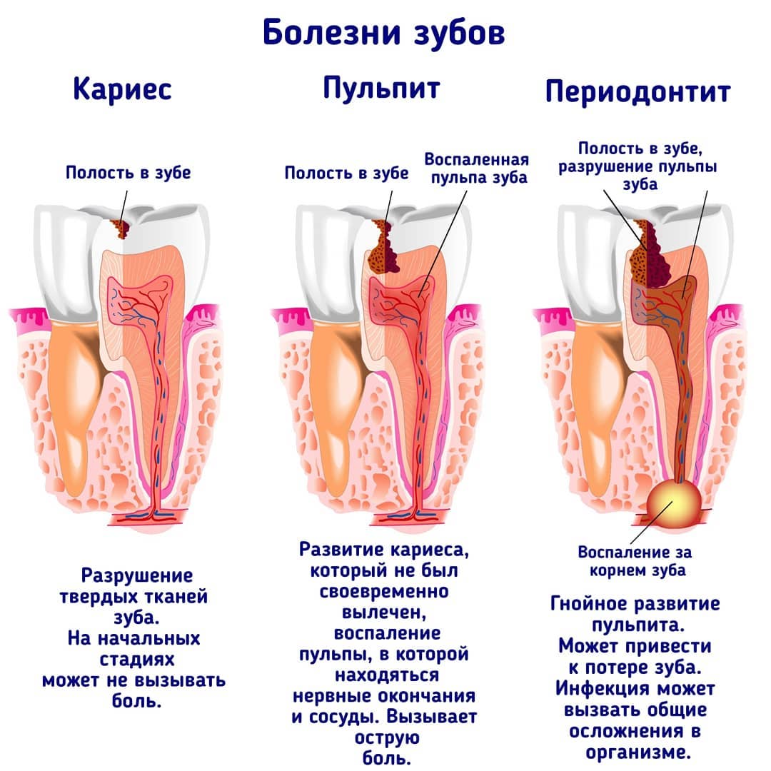 Лечение кариеса в стоматологии: виды кариеса и опасные осложнения