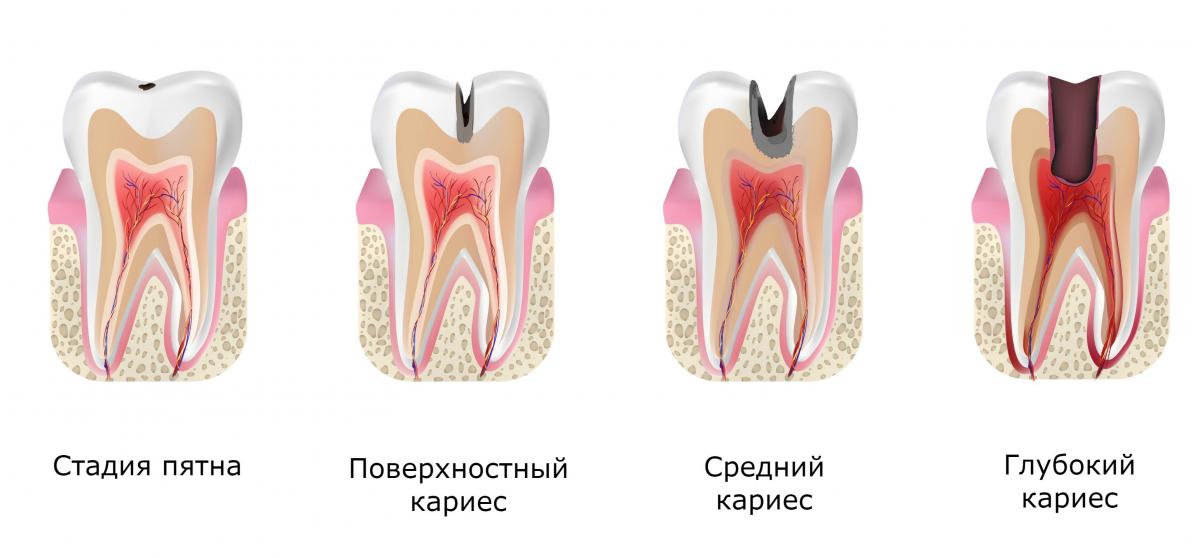 Лечение кариеса в стоматологии: виды кариеса и опасные осложнения