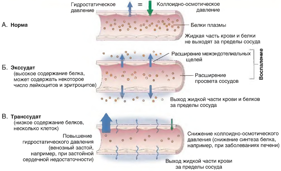 Образование экссудата и транссудата