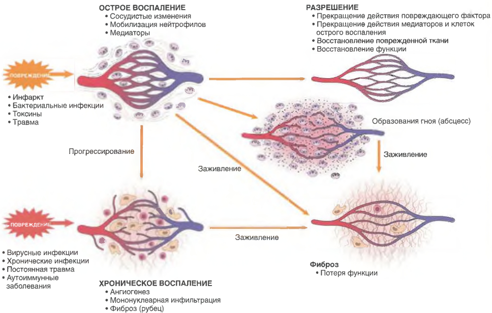 Исходы острого воспаления: