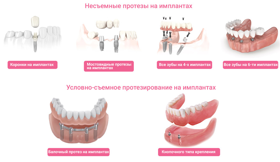 Виды несъемного протезирования зубов