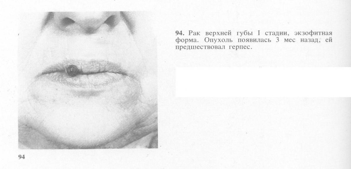 Рак губы: методы лечения, симптомы и предпосылки развития