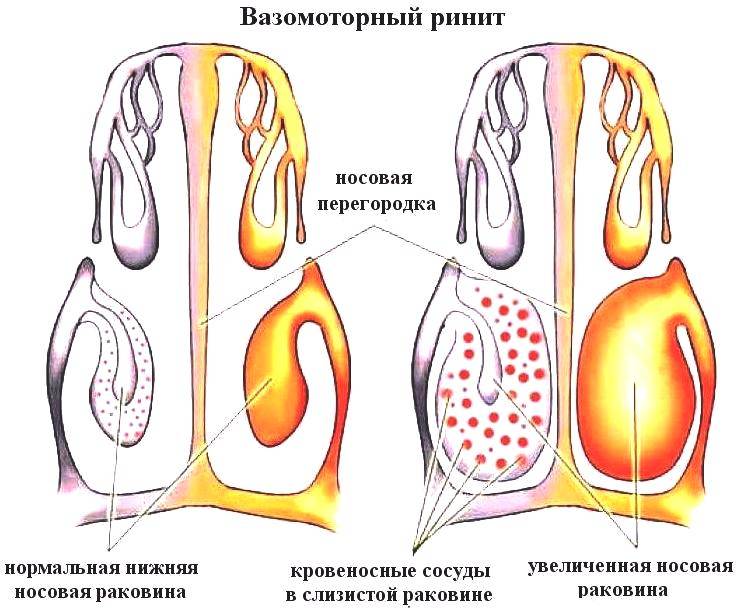Ринит: вирусный и вазомоторный. Симптомы и причины возникновения