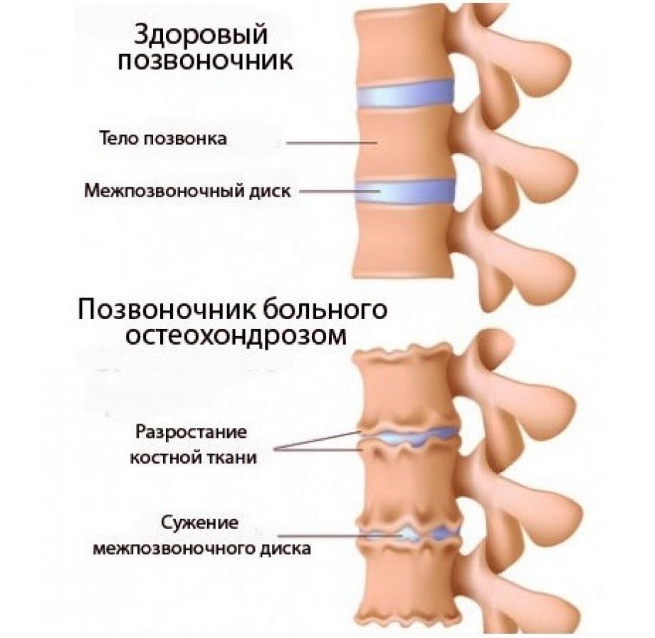 Лечение остеохондроза в санатории «Архипо-Осиповка»