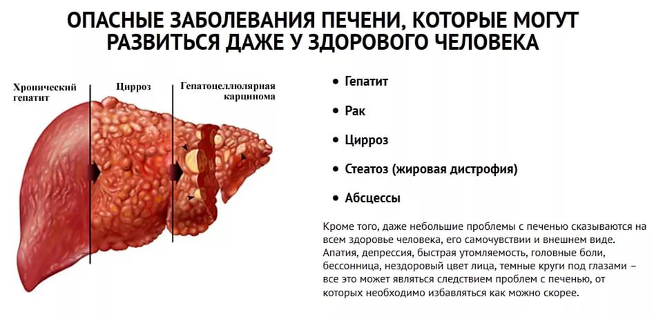 Заболевания печени: симптомы и методы диагностики