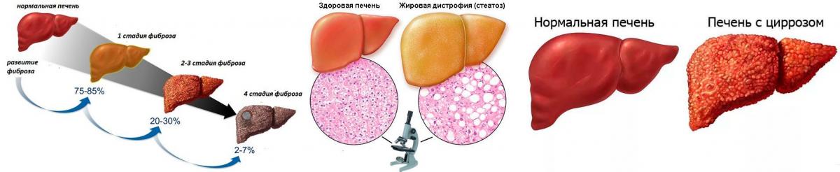 Заболевания печени: симптомы и методы диагностики