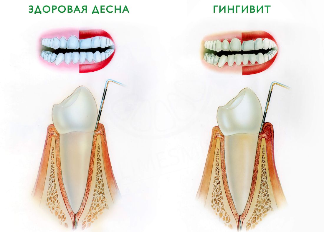 Гингивит