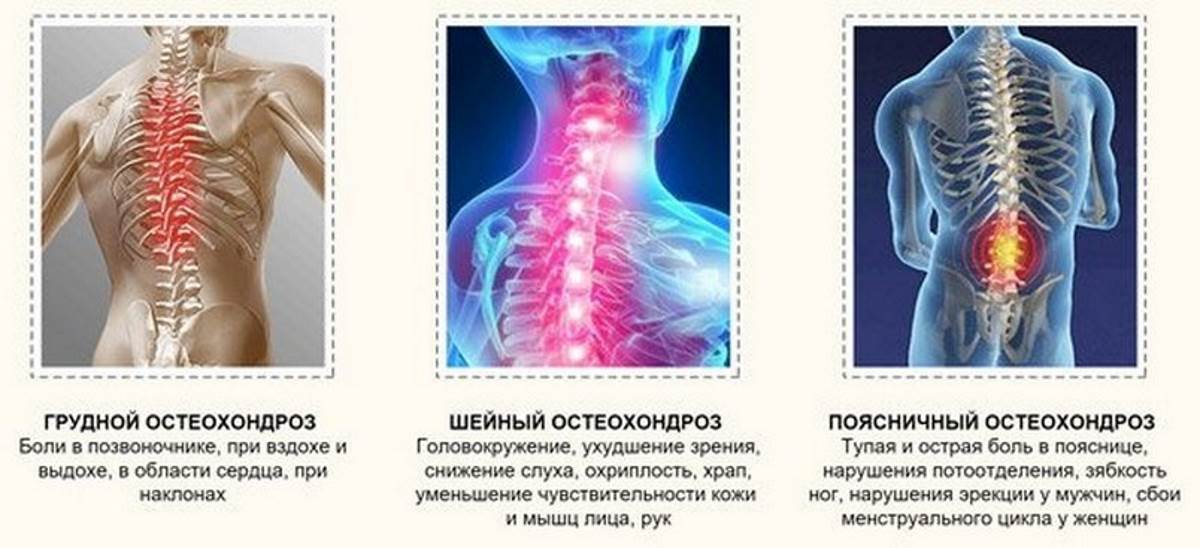 Какие существуют виды остеохондроза?
