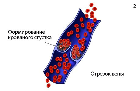 Тромбоз
