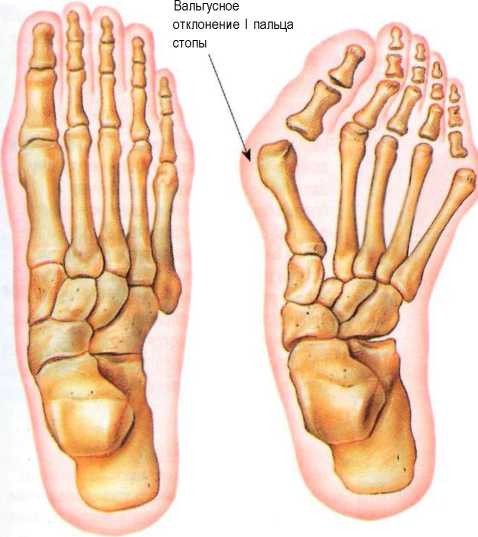 Hallux valgus — деформация большого пальца ноги