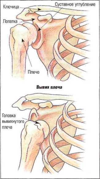 Вывих плеча