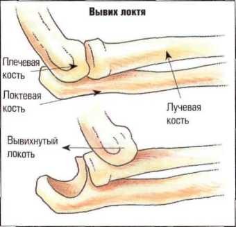 Вывих локтя