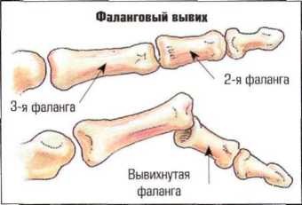Фаланговый вывих
