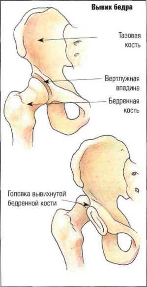 Вывих бедра